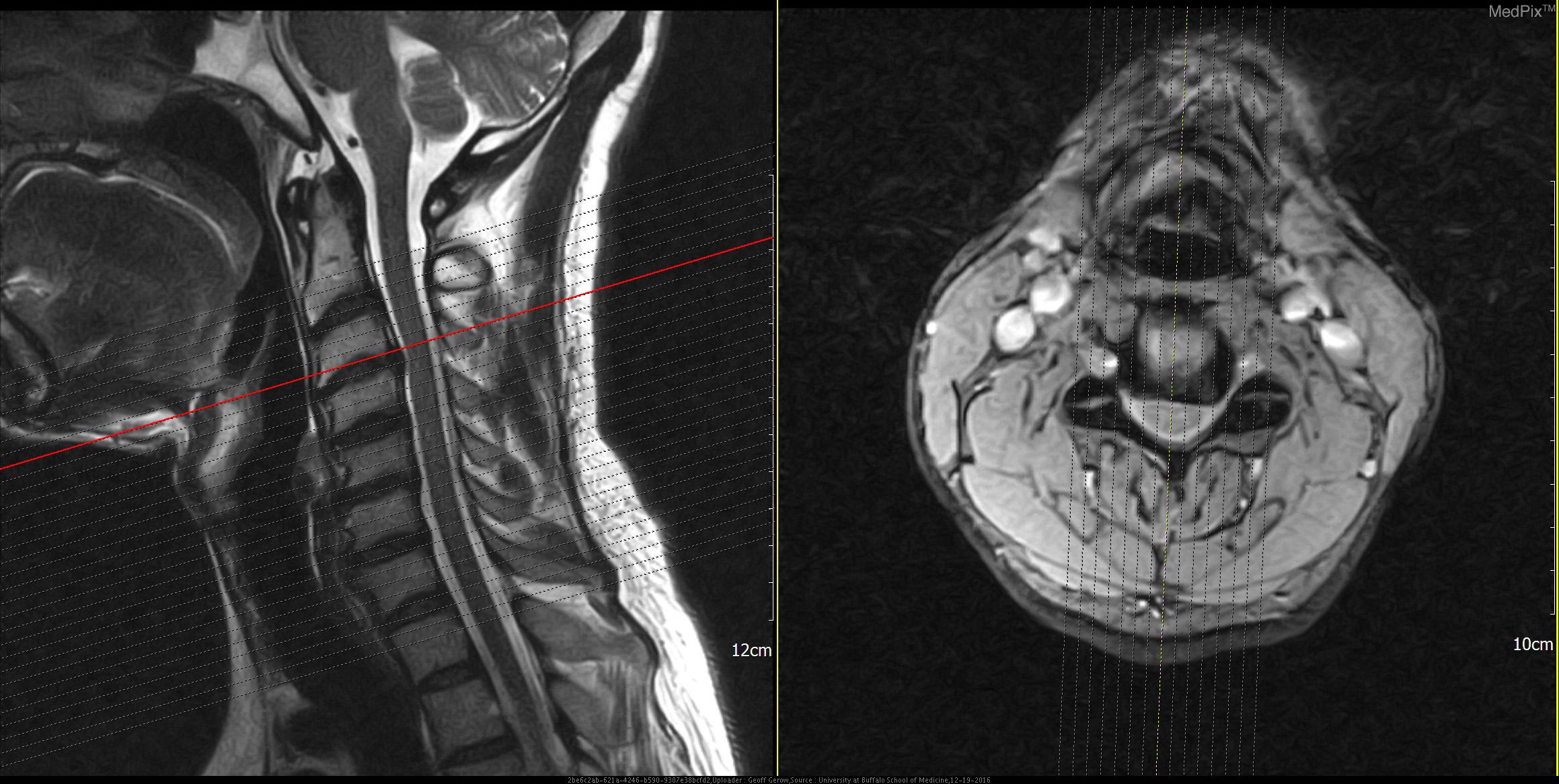 Sequestered Disc Herniation Mimicking Psoas Abscess A Rare 53 OFF